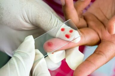 Sāpju diagnoze pirkstu locītavās
