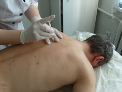 Hondroprotektoru intraartikulāras injekcijas krūšu kurvja osteohondrozei