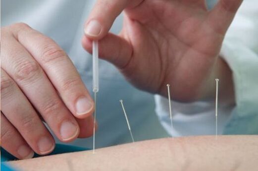 Akupunktūra ir osteohondrozes izraisītu sāpju ārstēšanas metode jostas rajonā