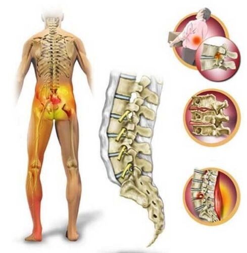 Mugurkaula jostas daļas osteohondroze, kas izraisa sāpes muguras lejasdaļā